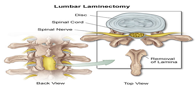 Laminectomy Discharge Instructions